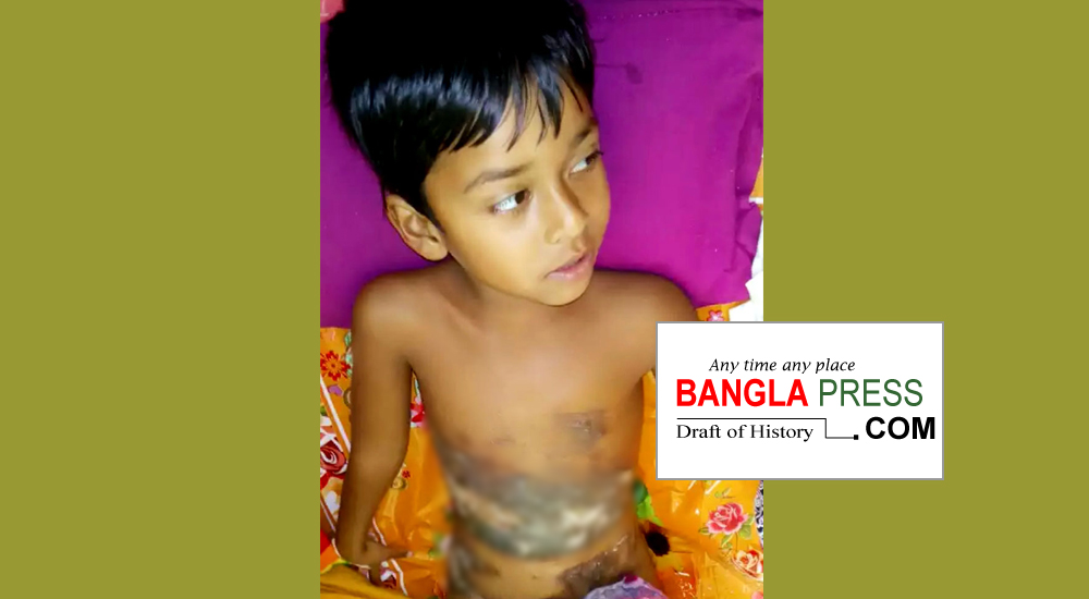 অগ্নিদগ্ধ শিশু সাথীকে বাঁচাতে সাহায্যের আবেদন